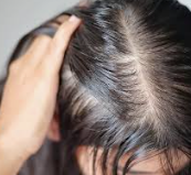 Causes of hair loss, Hair loss, thinning hair